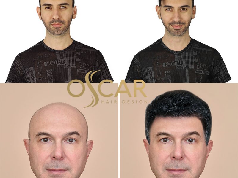 Protez Saç ve Bakım Merkezi Oscar Hair: Protez Saç Tasarım ve Bakım Merkezi